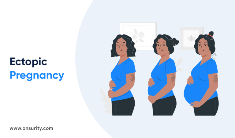 Everything You Need to Know About Ectopic Pregnancy 